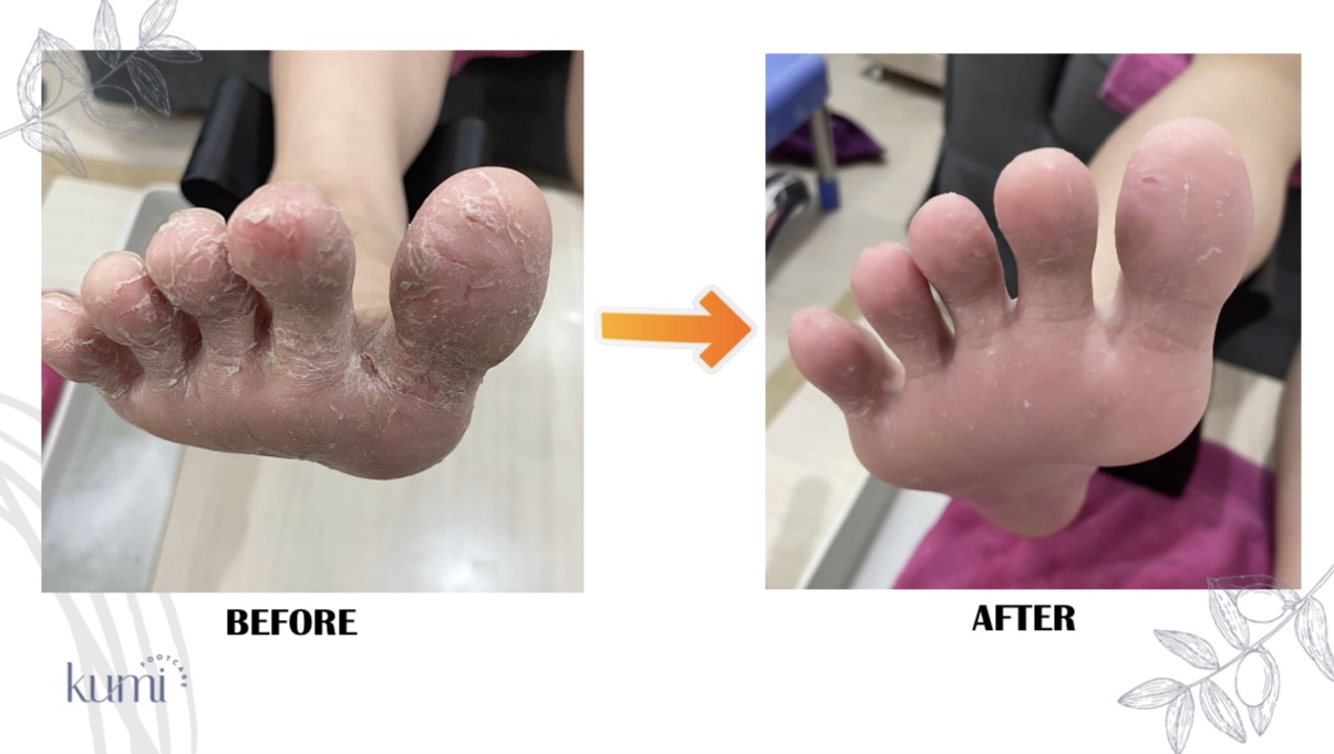 callus-pedicure-manicure-kutikula-kumi.jpg