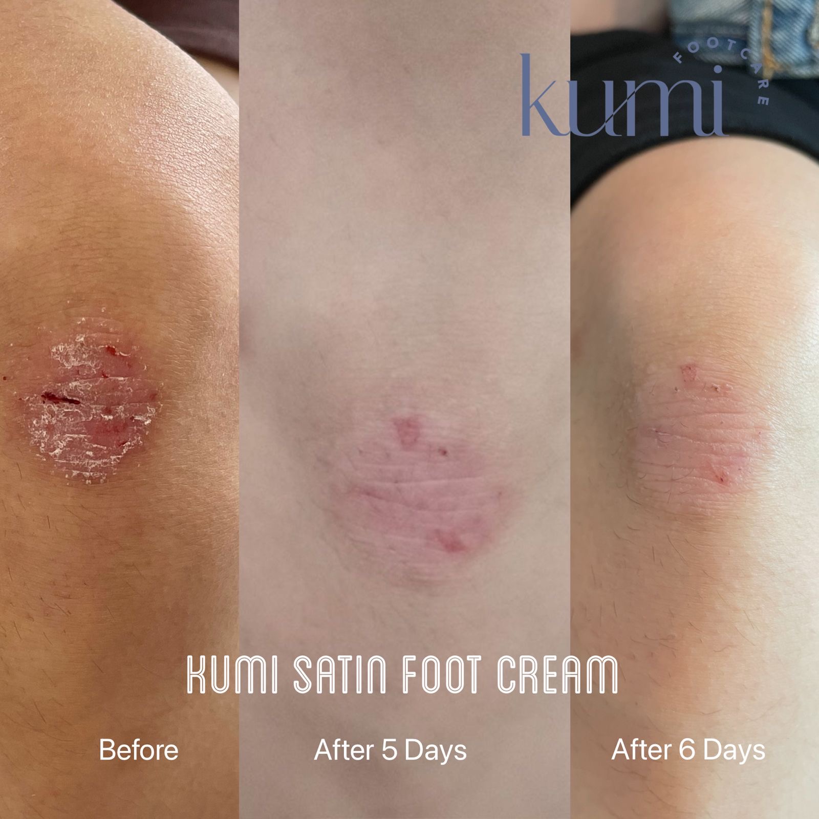 callus-pedicure-manicure-kutikula-kumi.jpg
