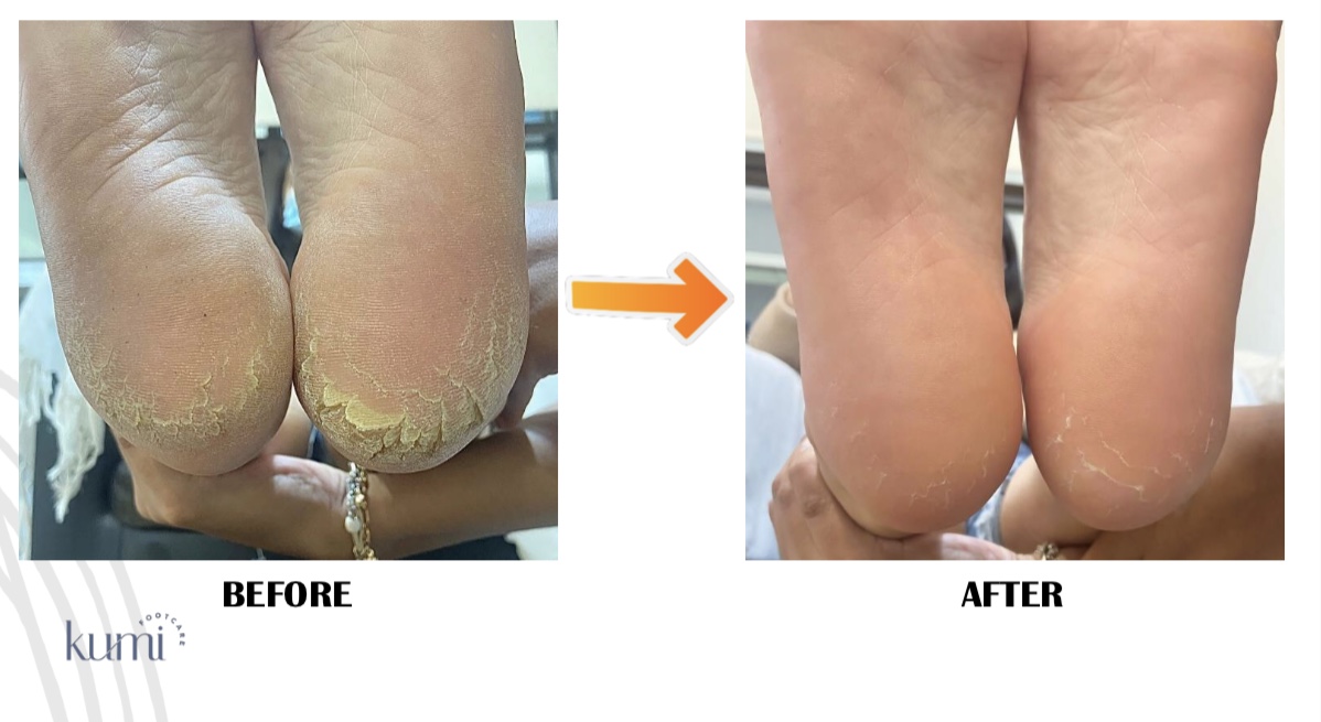 callus-pedicure-manicure-kutikula-kumi.jpg