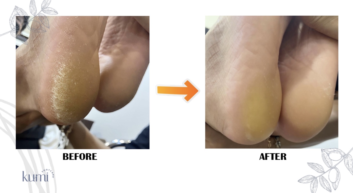 callus-pedicure-manicure-kutikula-kumi.jpg