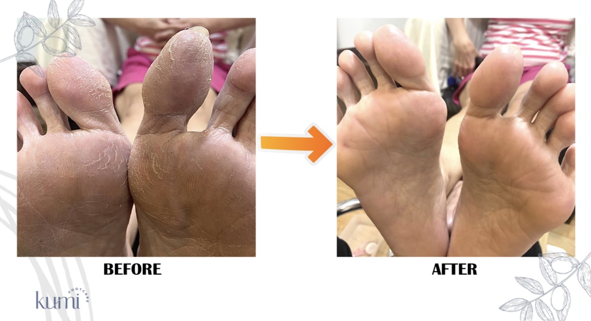 callus-pedicure-manicure-kutikula-kumi.jpg